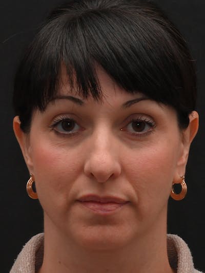 Rhinoplasty Before & After Gallery - Patient 147389 - Image 1