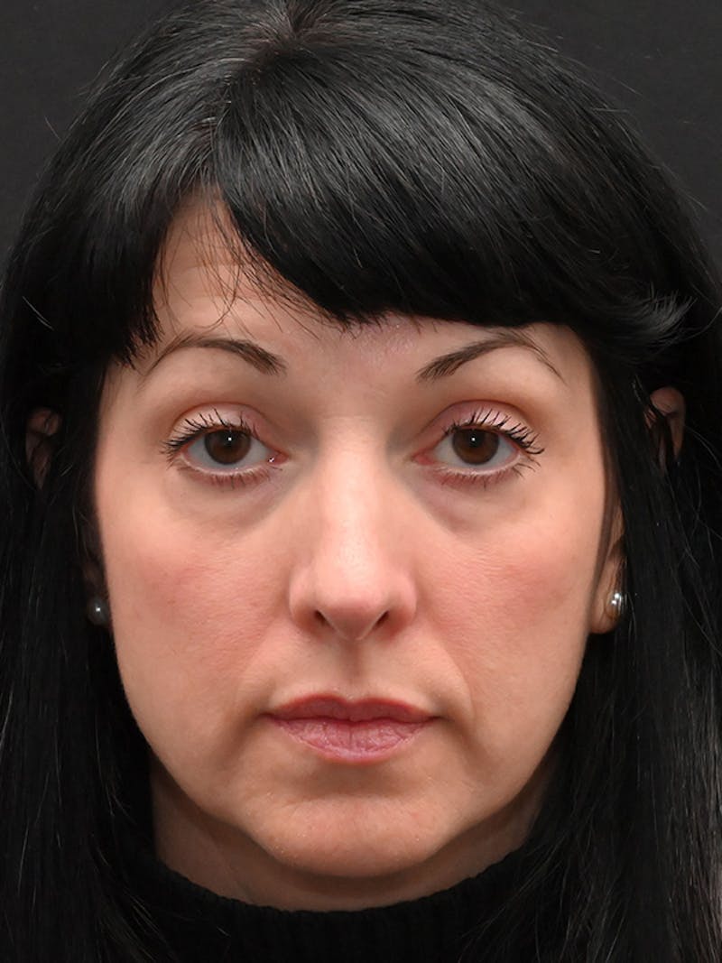 Rhinoplasty Before & After Gallery - Patient 147389 - Image 2