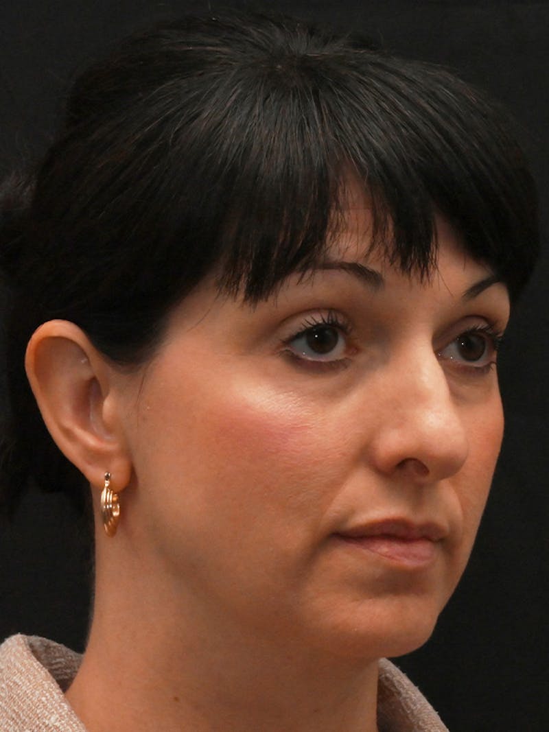 Rhinoplasty Before & After Gallery - Patient 147389 - Image 3