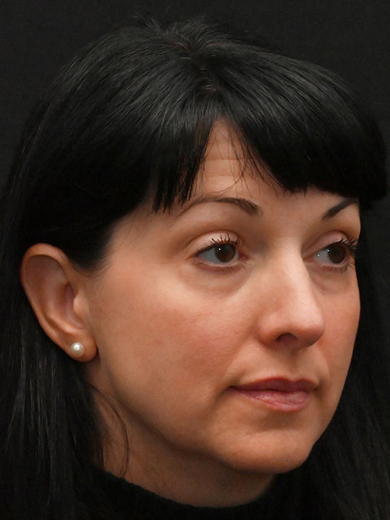 Rhinoplasty Before & After Gallery - Patient 147389 - Image 4