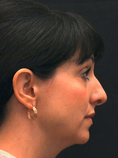 Rhinoplasty Before & After Gallery - Patient 147389 - Image 1