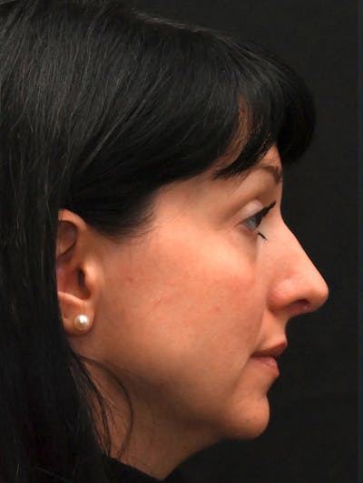 Rhinoplasty Before & After Gallery - Patient 147389 - Image 2