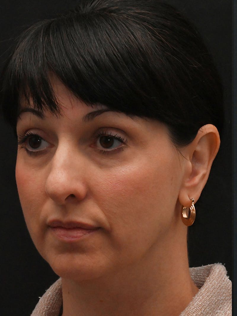 Rhinoplasty Before & After Gallery - Patient 147389 - Image 7