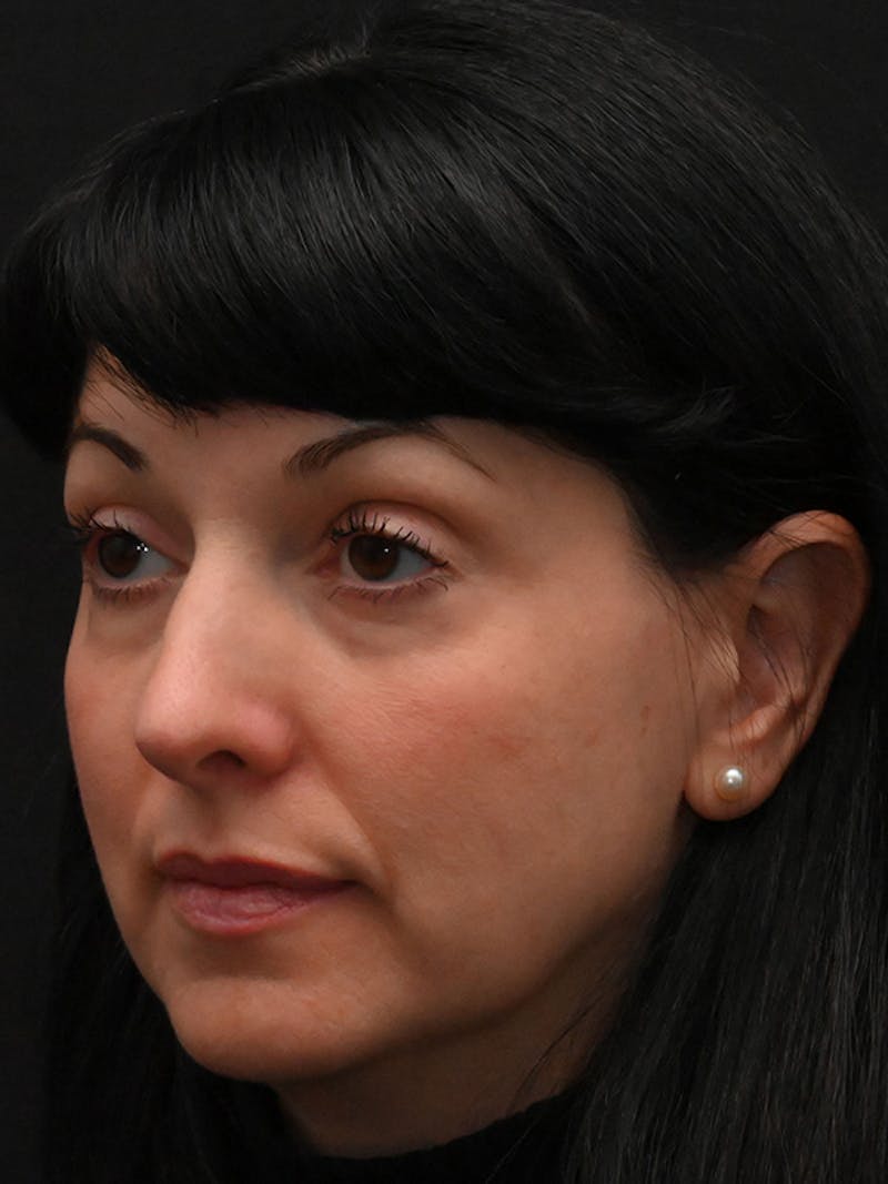 Rhinoplasty Before & After Gallery - Patient 147389 - Image 8