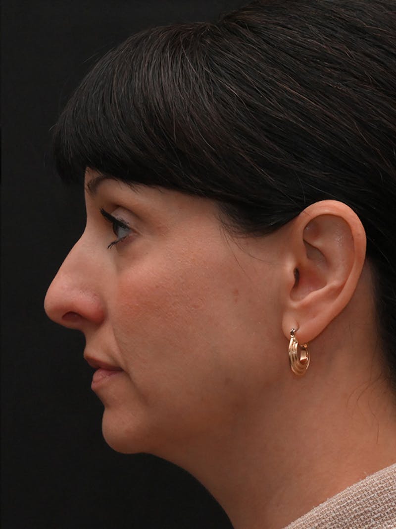 Rhinoplasty Before & After Gallery - Patient 147389 - Image 9