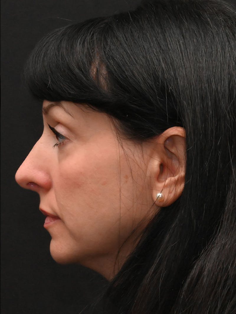 Rhinoplasty Before & After Gallery - Patient 147389 - Image 10