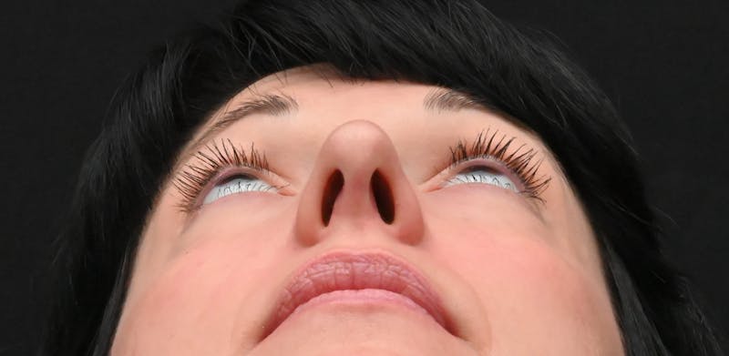 Rhinoplasty Before & After Gallery - Patient 147389 - Image 12