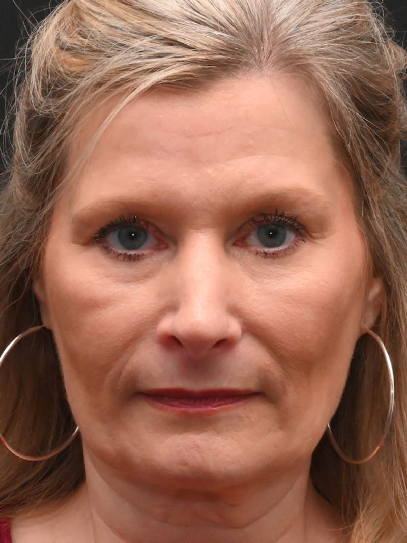 Rhinoplasty Before & After Gallery - Patient 156052 - Image 2