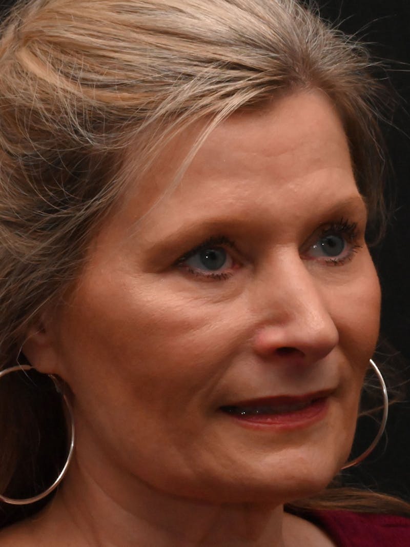 Rhinoplasty Before & After Gallery - Patient 156052 - Image 4