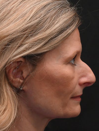 Rhinoplasty Before & After Gallery - Patient 156052 - Image 1
