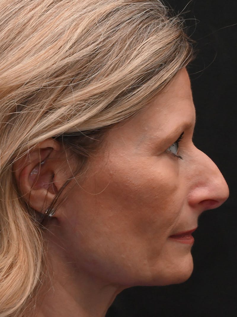 Rhinoplasty Before & After Gallery - Patient 156052 - Image 5