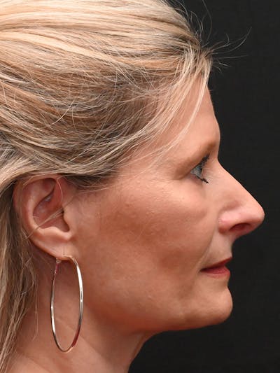 Rhinoplasty Before & After Gallery - Patient 156052 - Image 2