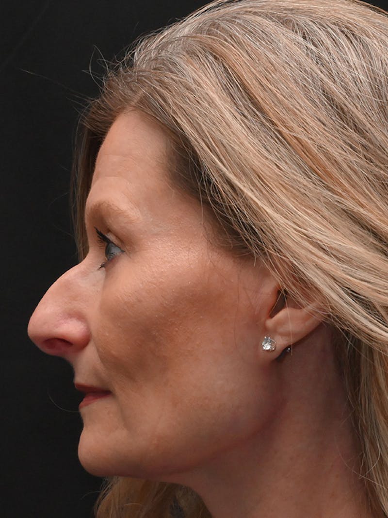 Rhinoplasty Before & After Gallery - Patient 156052 - Image 9