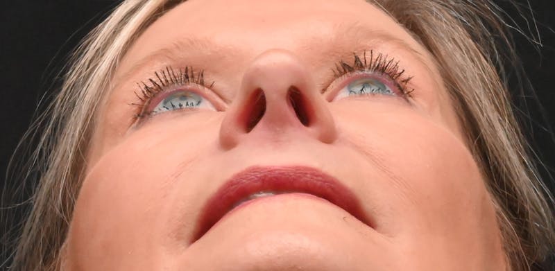 Rhinoplasty Before & After Gallery - Patient 156052 - Image 12