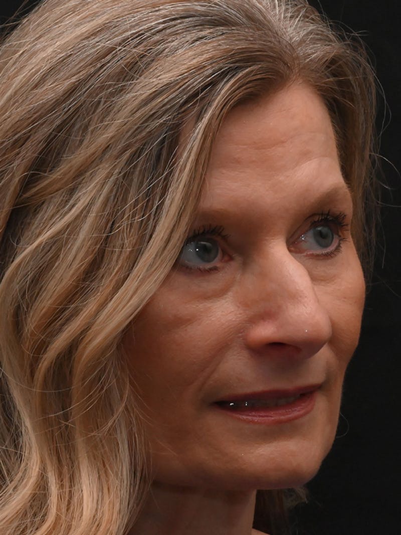 Rhinoplasty Before & After Gallery - Patient 156052 - Image 3