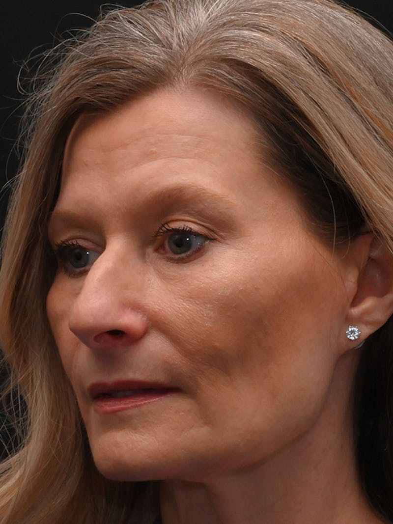 Rhinoplasty Before & After Gallery - Patient 156052 - Image 7