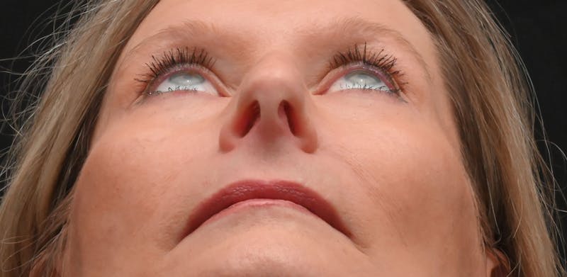 Rhinoplasty Before & After Gallery - Patient 156052 - Image 11