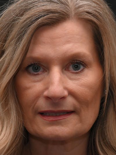 Rhinoplasty Before & After Gallery - Patient 156052 - Image 1