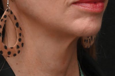 Facelift Before & After Gallery - Patient 293713 - Image 1