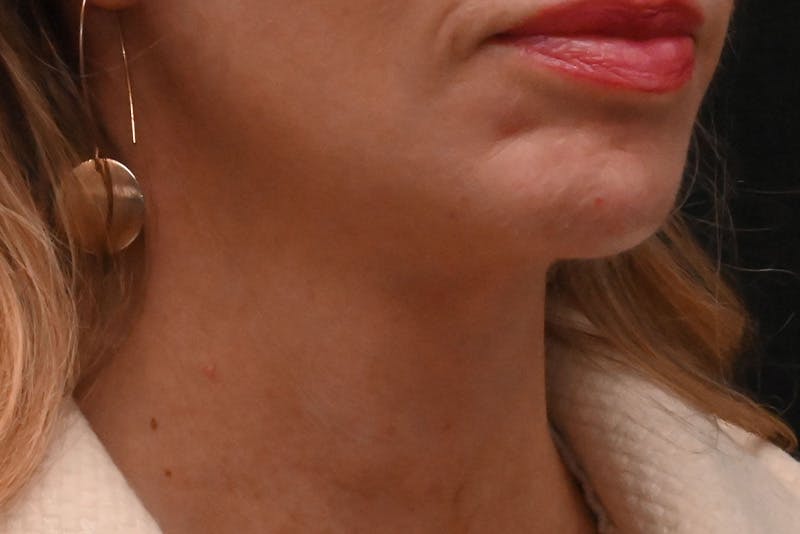 Facelift Before & After Gallery - Patient 293713 - Image 2