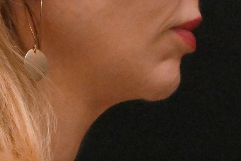 Facelift Before & After Gallery - Patient 293713 - Image 4