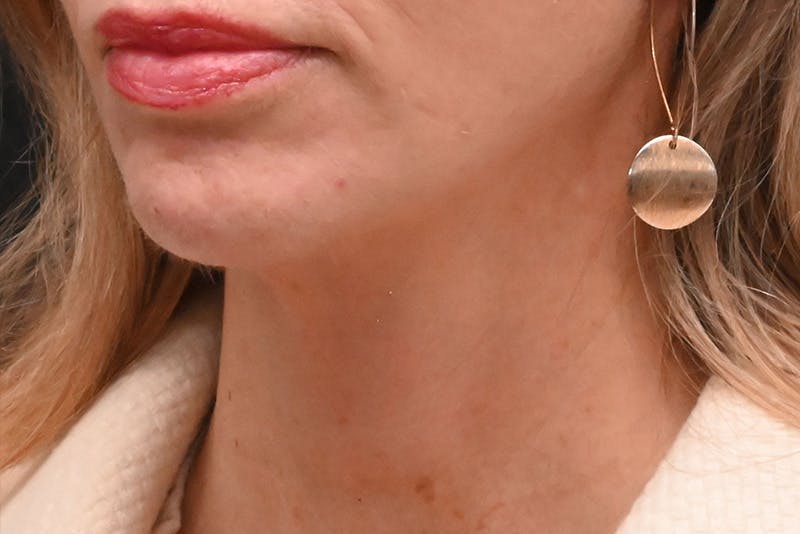 Facelift Before & After Gallery - Patient 293713 - Image 6