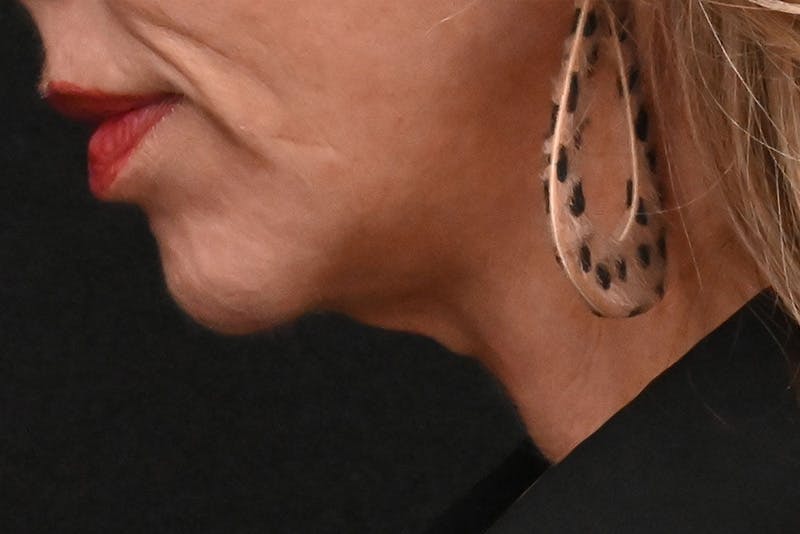 Facelift Before & After Gallery - Patient 293713 - Image 7