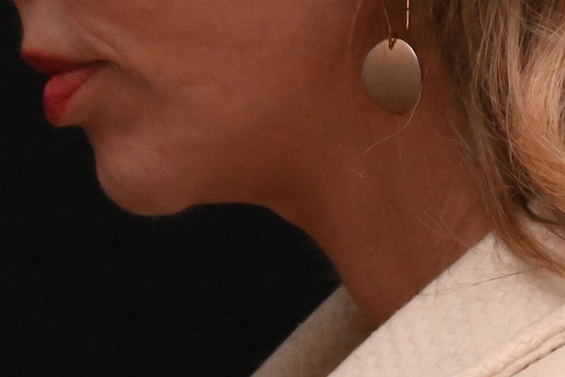 Facelift Before & After Gallery - Patient 293713 - Image 8