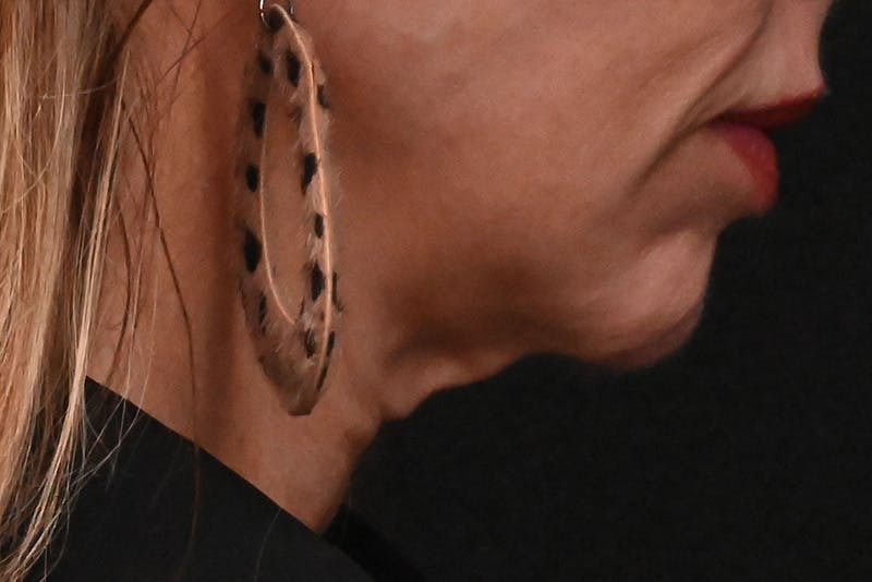 Facelift Before & After Gallery - Patient 293713 - Image 3