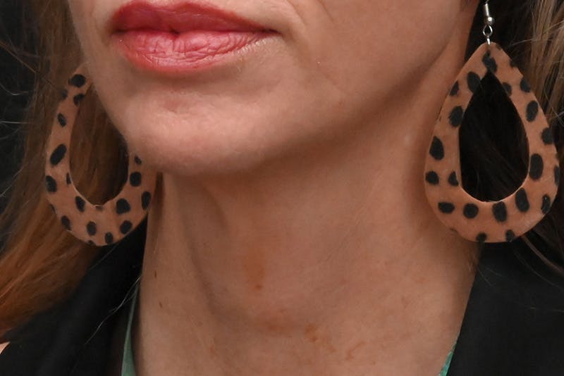 Facelift Before & After Gallery - Patient 293713 - Image 5