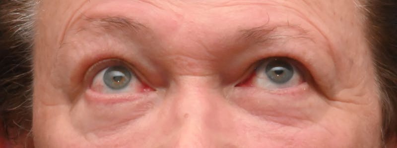 Eyelid Surgery Before & After Gallery - Patient 256924 - Image 4