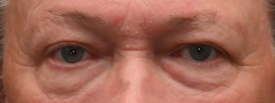 Eyelid Surgery Before & After Gallery - Patient 256924 - Image 1