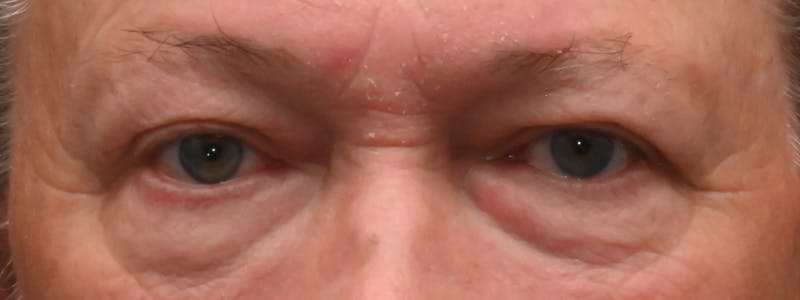 Eyelid Surgery Before & After Gallery - Patient 256924 - Image 1