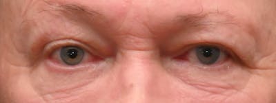Eyelid Surgery Before & After Gallery - Patient 256924 - Image 2