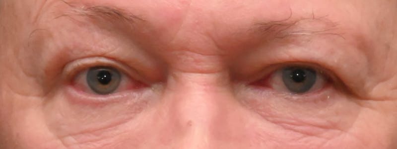 Eyelid Surgery Before & After Gallery - Patient 256924 - Image 2