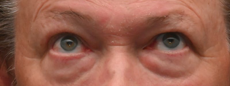 Eyelid Surgery Before & After Gallery - Patient 256924 - Image 3