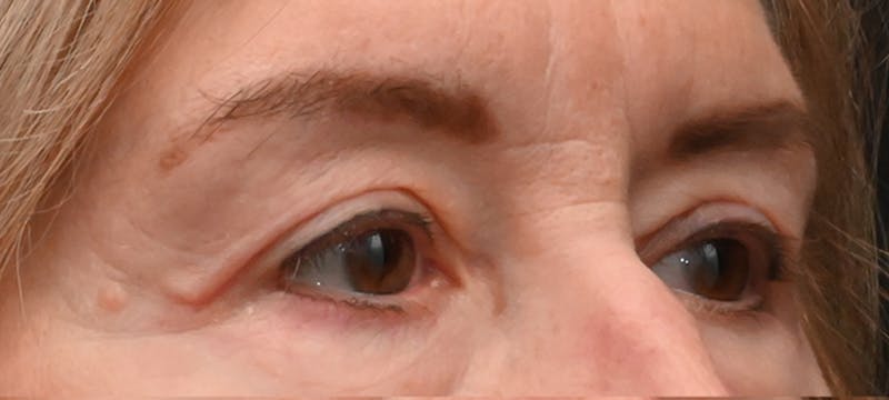 Eyelid Surgery Before & After Gallery - Patient 511783 - Image 6