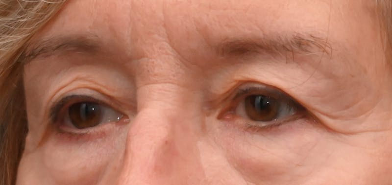 Eyelid Surgery Before & After Gallery - Patient 511783 - Image 3