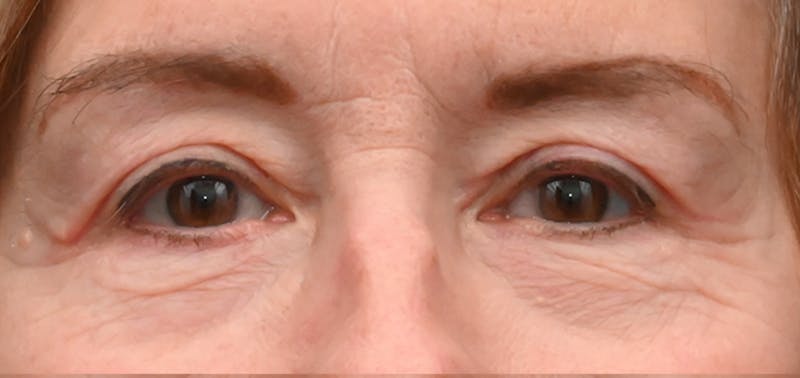 Eyelid Surgery Before & After Gallery - Patient 511783 - Image 2