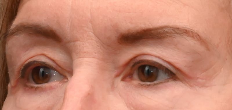 Eyelid Surgery Before & After Gallery - Patient 511783 - Image 4