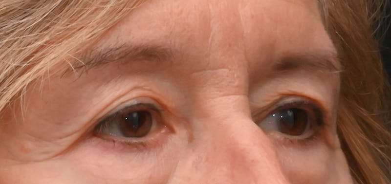 Eyelid Surgery Before & After Gallery - Patient 511783 - Image 5