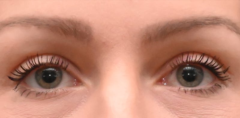 Eyelid Surgery Before & After Gallery - Patient 382235 - Image 2
