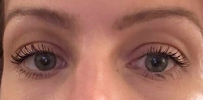 Eyelid Surgery Before & After Gallery - Patient 382235 - Image 1