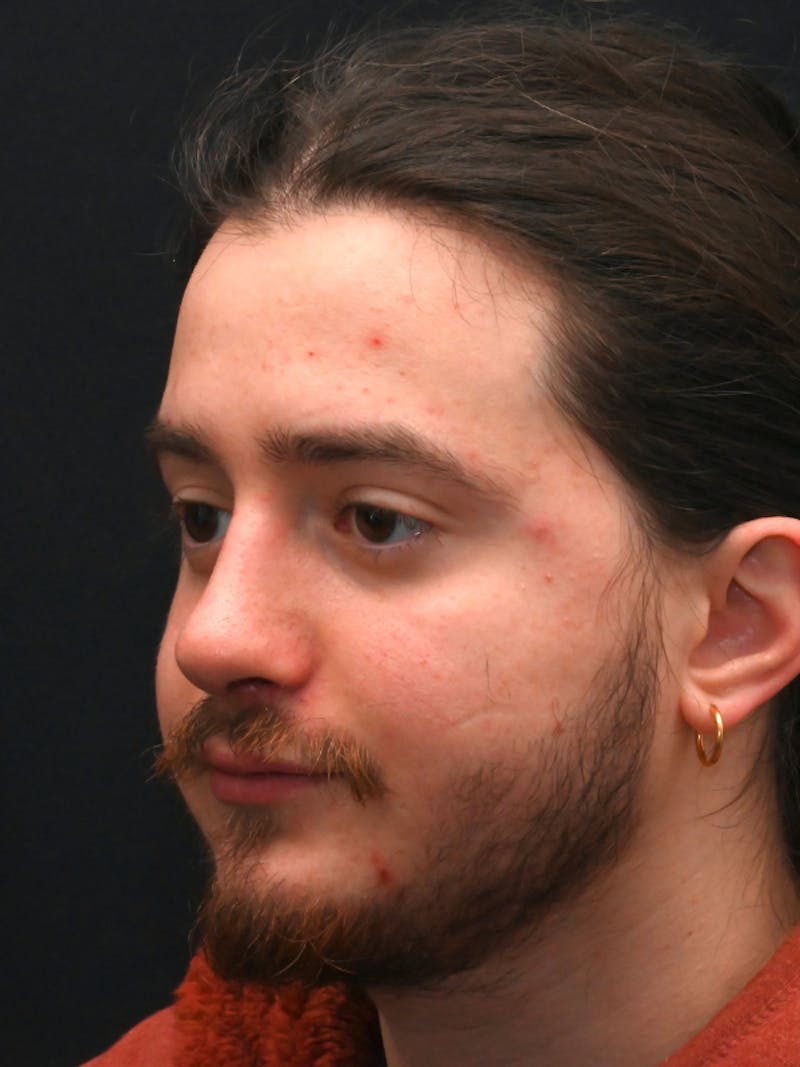 Rhinoplasty Before & After Gallery - Patient 172696 - Image 6