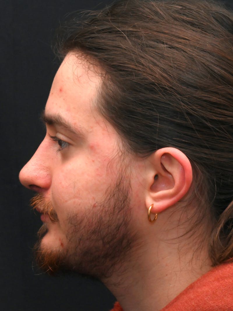 Rhinoplasty Before & After Gallery - Patient 172696 - Image 8