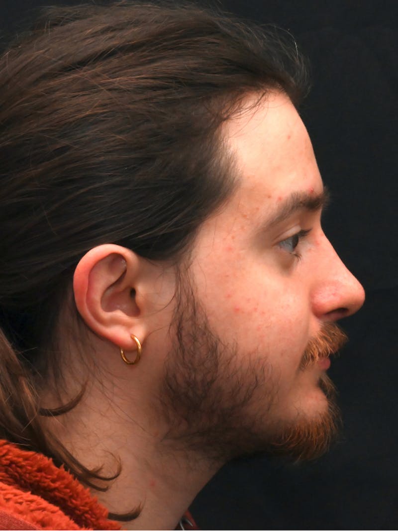 Rhinoplasty Before & After Gallery - Patient 172696 - Image 2