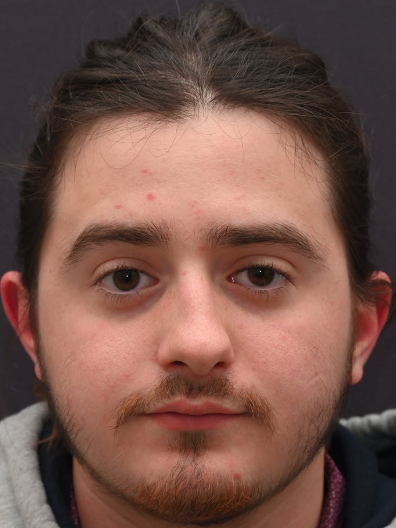 Rhinoplasty Before & After Gallery - Patient 172696 - Image 3