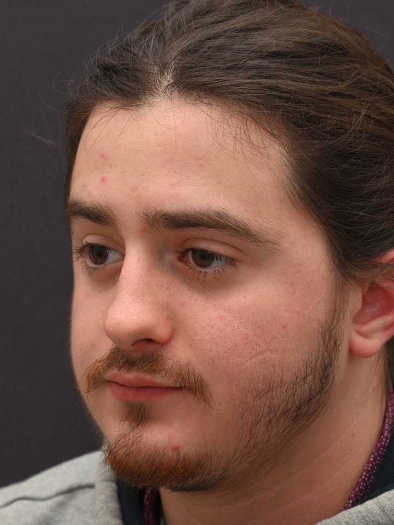 Rhinoplasty Before & After Gallery - Patient 172696 - Image 5