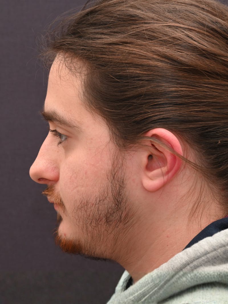 Rhinoplasty Before & After Gallery - Patient 172696 - Image 7
