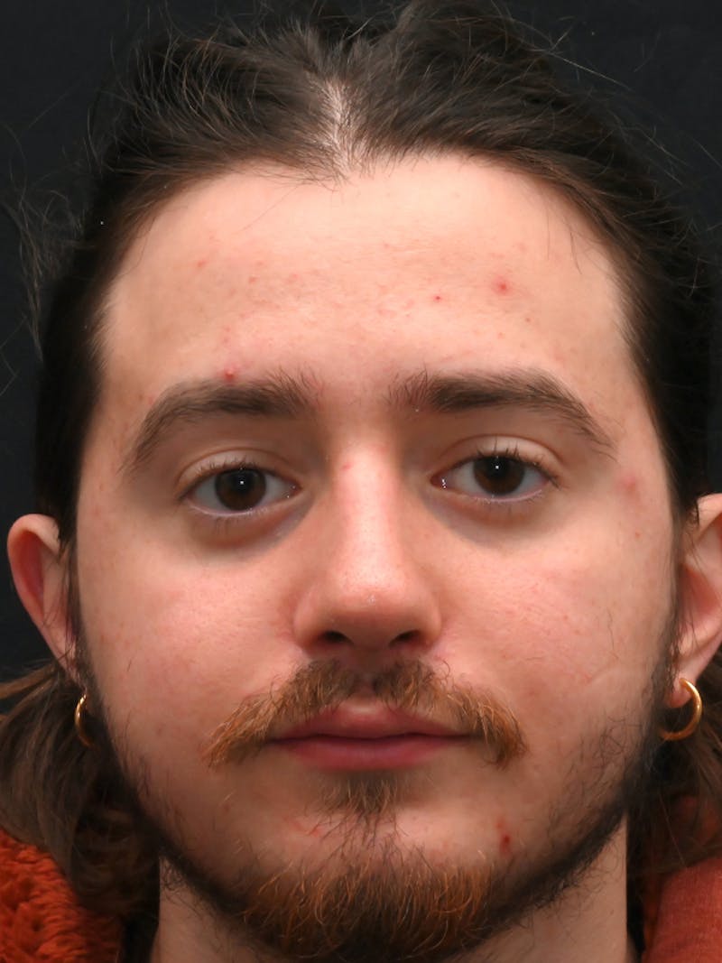 Rhinoplasty Before & After Gallery - Patient 172696 - Image 4